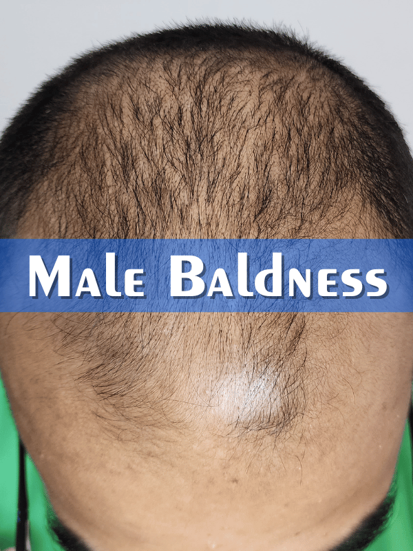 Male Baldness Treatment